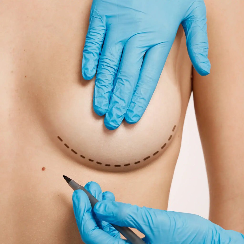Breast Augmentation In Tijuana, Mexico 15 Plastic surgeon marking the incision line on a patient's breast fold for breast augmentation, ensuring hidden scars and precise implant placement.