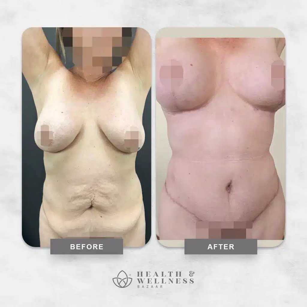 Mommy makeover Landing 16 Before and after mommy makeover result showing body contouring and breast enhancement outcome.