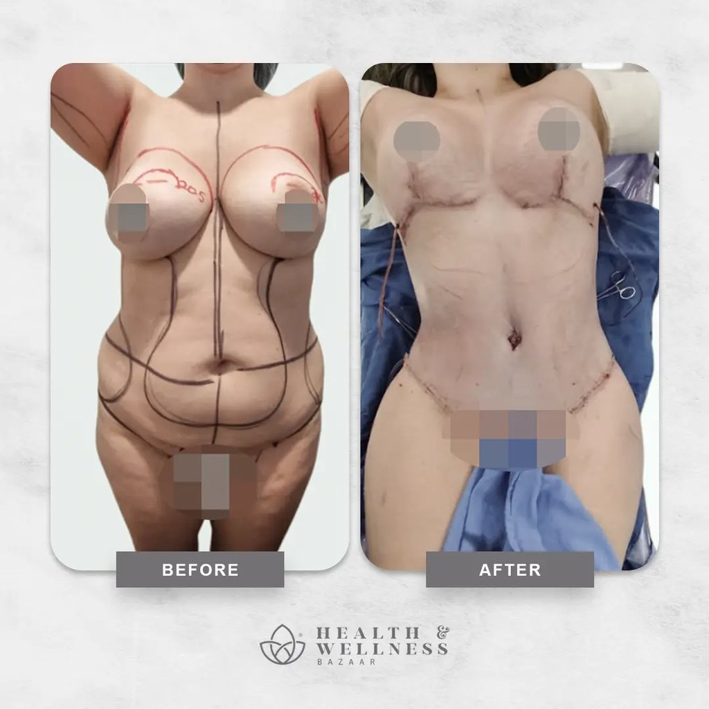 Mommy makeover Landing 17 Before and after mommy makeover image showing surgical planning marks and postoperative body contour result.