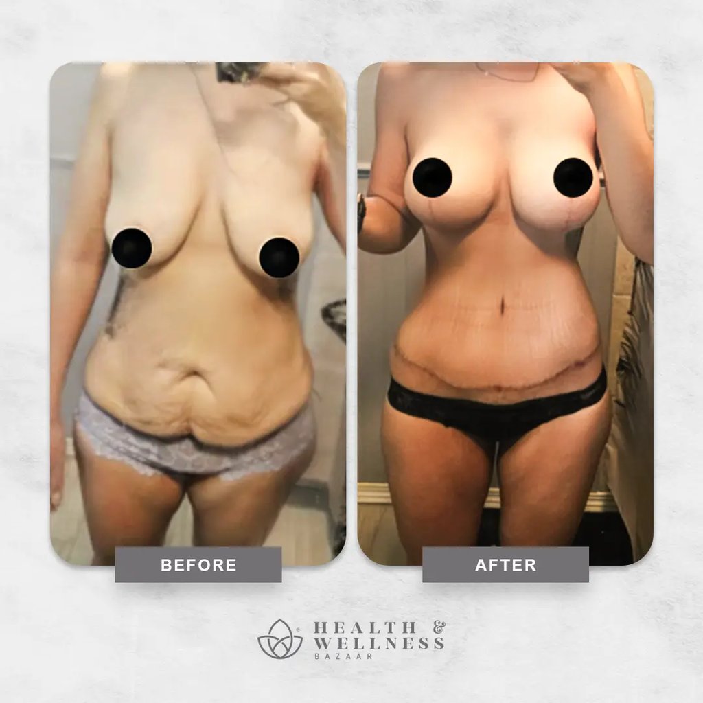 Mommy makeover Landing 18 Before and after mommy makeover result showing abdominal contouring and breast shape improvement.