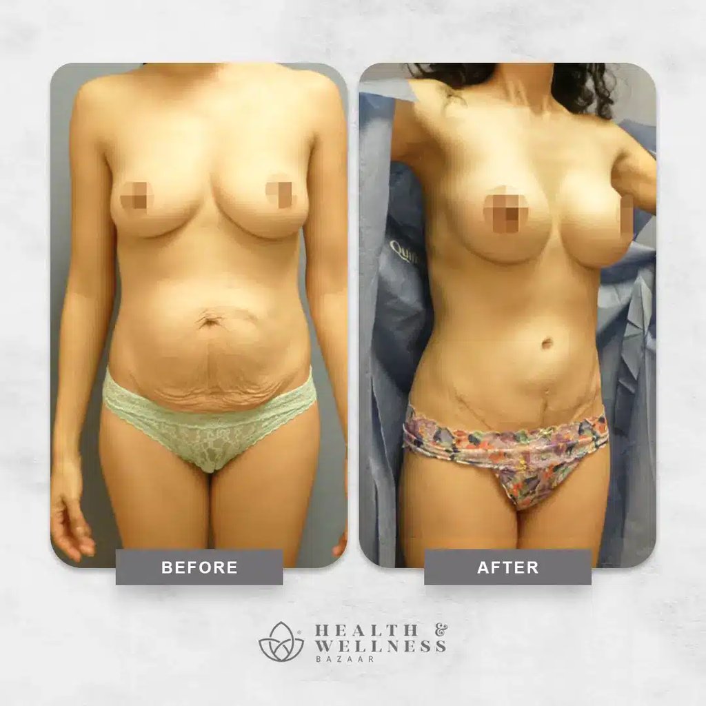 Mommy makeover Landing 19 Before and after mommy makeover result showing improved waist contour and abdominal appearance.