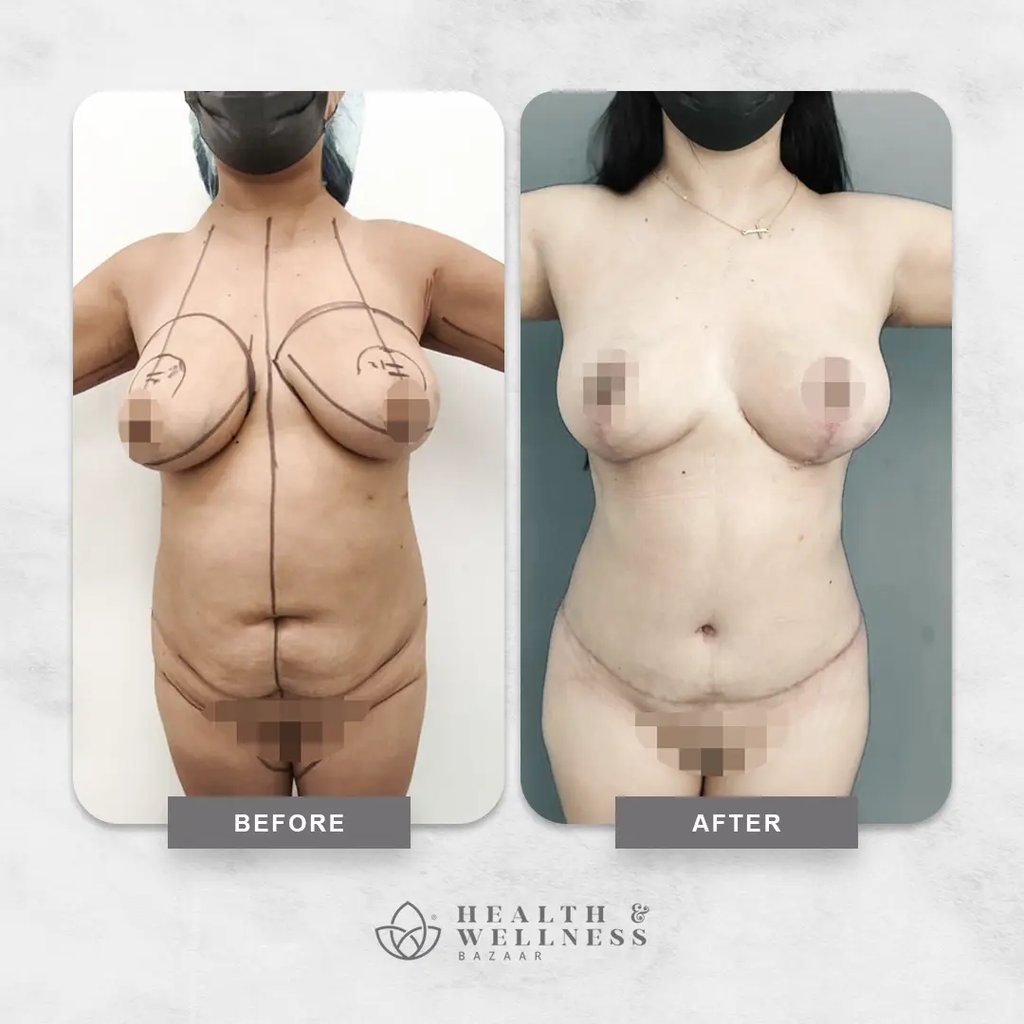 Mommy makeover Landing 20 Before and after mommy makeover result showing breast contour improvement and abdominal body contouring.