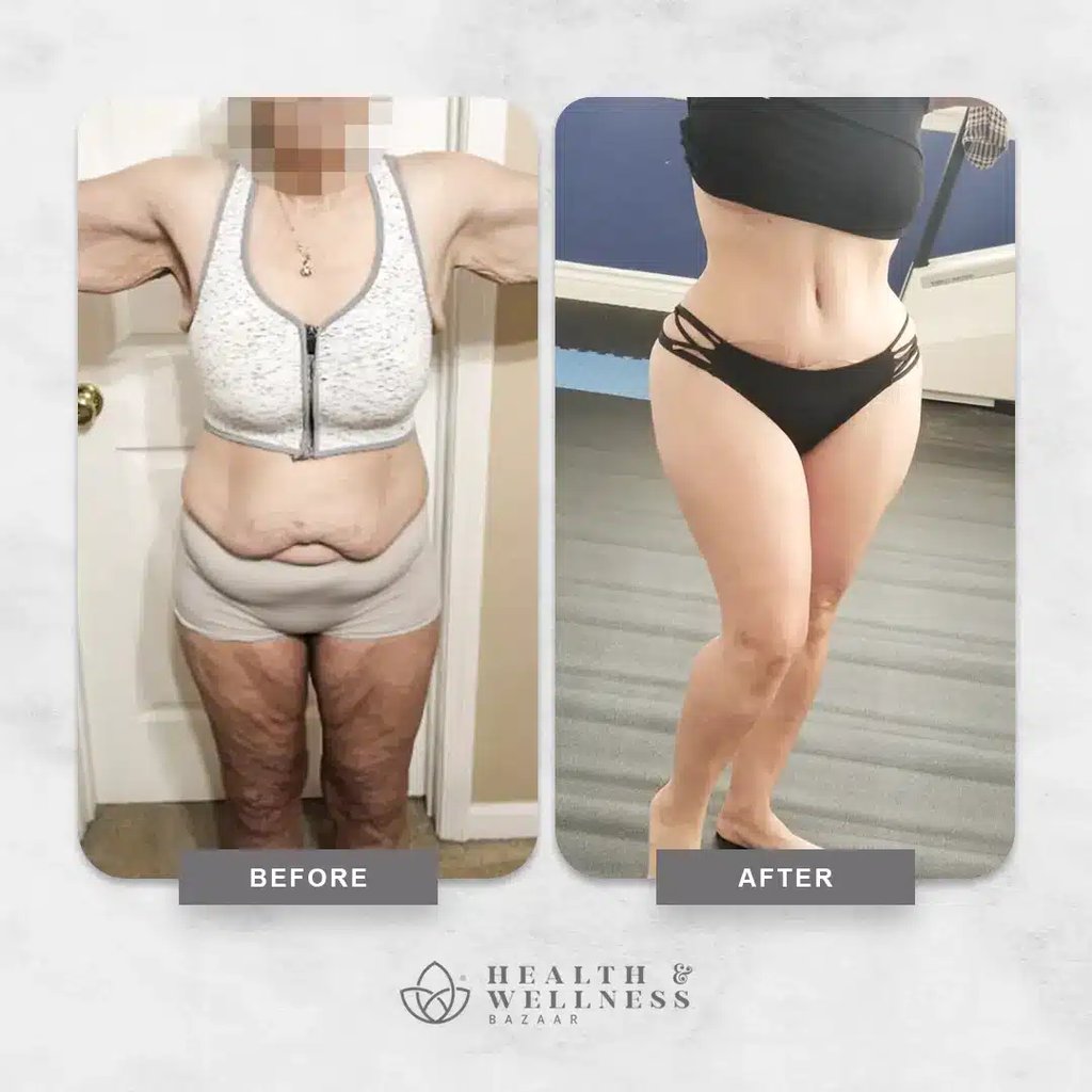 Mommy makeover Landing 21 Before and after mommy makeover transformation showing improved waistline and abdominal contour.