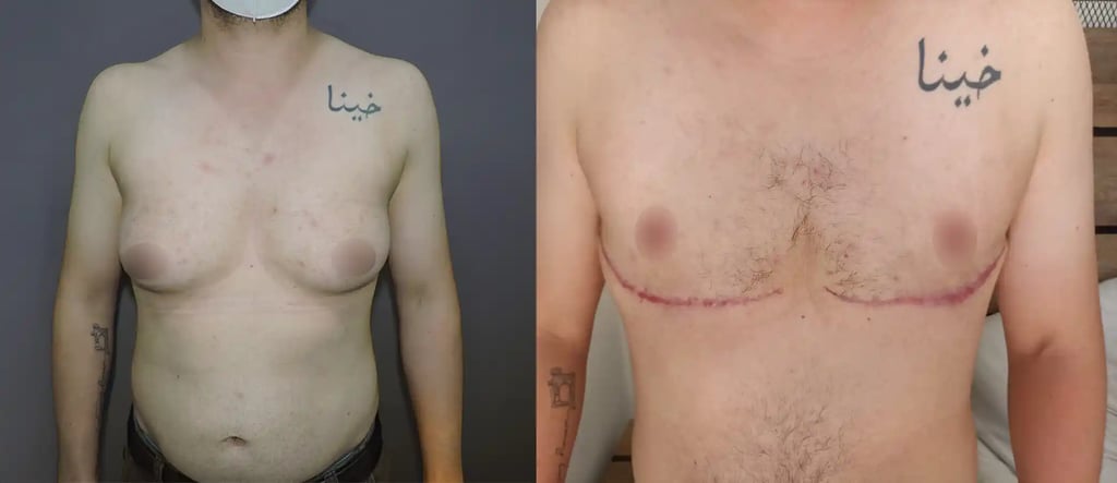 Before and after comparison of FTM Top Surgery, showing a flat, masculinized chest after subcutaneous mastectomy performed by Tijuana surgeons.