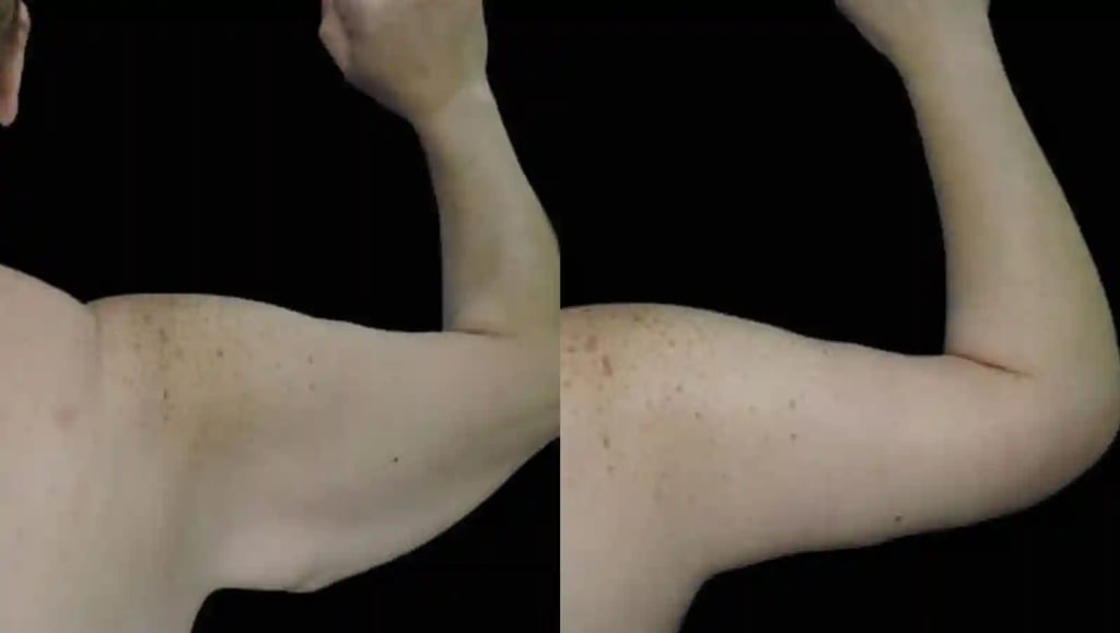 Before and after photos of a Brachioplasty in Tijuana; the left image shows "bat wings" and the right shows a toned, firm arm.
