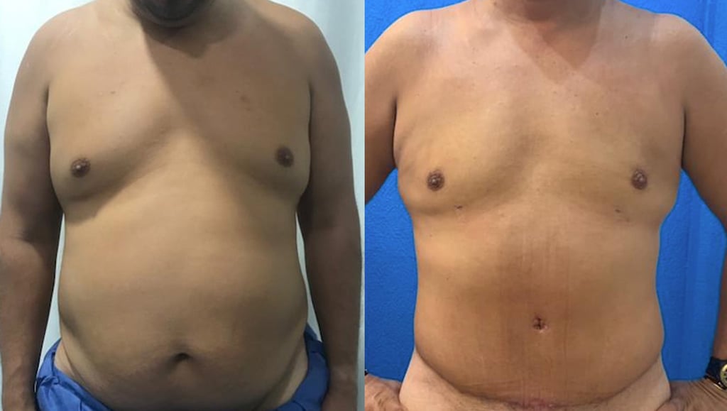Before and after comparison of male tummy tuck and chest contouring (gynecomastia surgery) in Tijuana, showing removal of excess skin and fat by board-certified plastic surgeons Mexico.