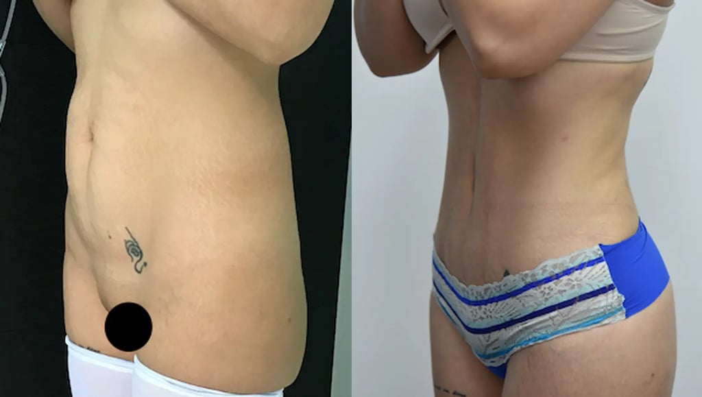 Side profile view showing dramatic tummy tuck (abdominoplasty) results in Tijuana, highlighting a flat stomach and skin removal as part of a mommy makeover or post-weight loss surgery.