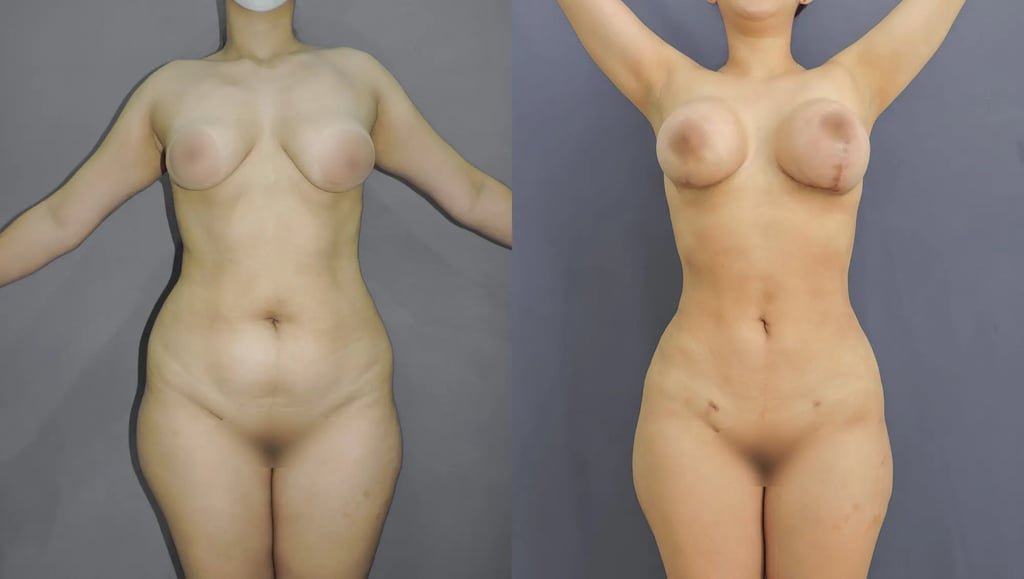 Frontal before and after comparison of liposuction results, highlighting a snatched waist and flat abdomen achieved through high-definition liposculpture Tijuana.