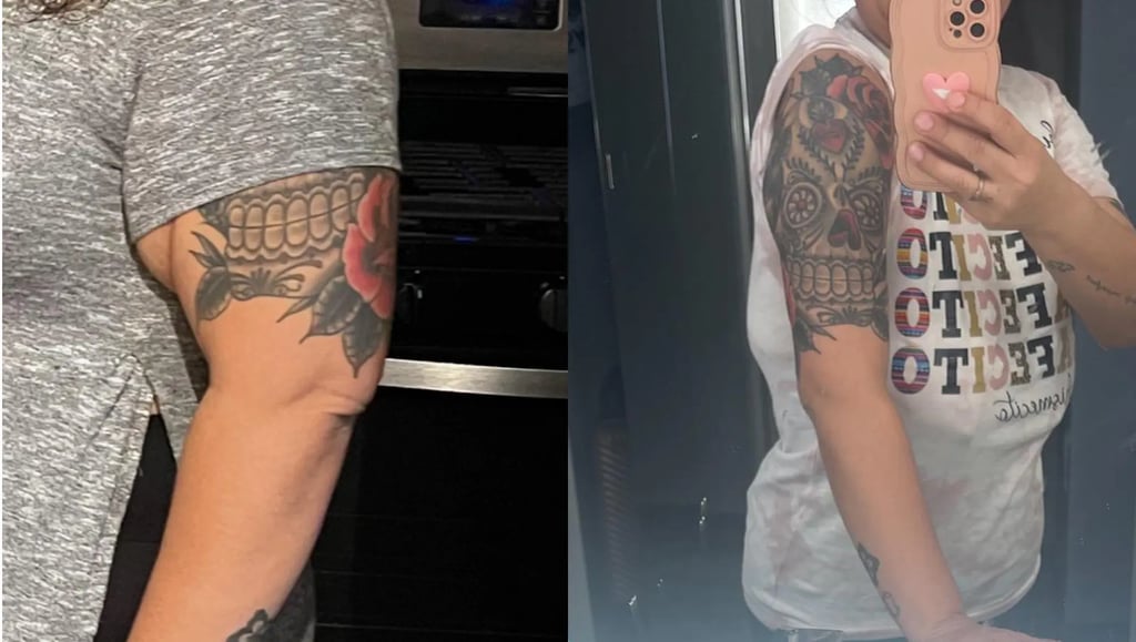 Patient results showing the removal of excess skin on the arms after a successful brachioplasty in Tijuana.