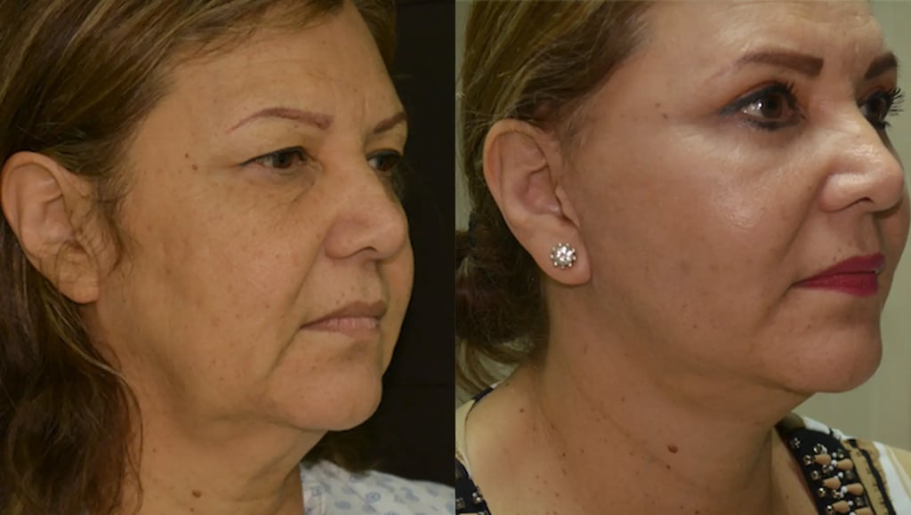 Side profile before and after showing significant jawline and neck improvement after a deep plane facelift in Tijuana.