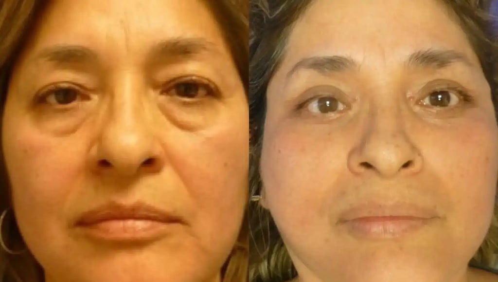 Close-up before and after of eyelid surgery in Tijuana showing the correction of under-eye bags and sagging upper lids.