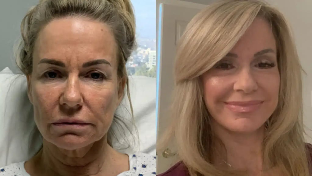 Before and after of a female patient who underwent facelift and eyelid surgery in Tijuana, showing significant facial rejuvenation.