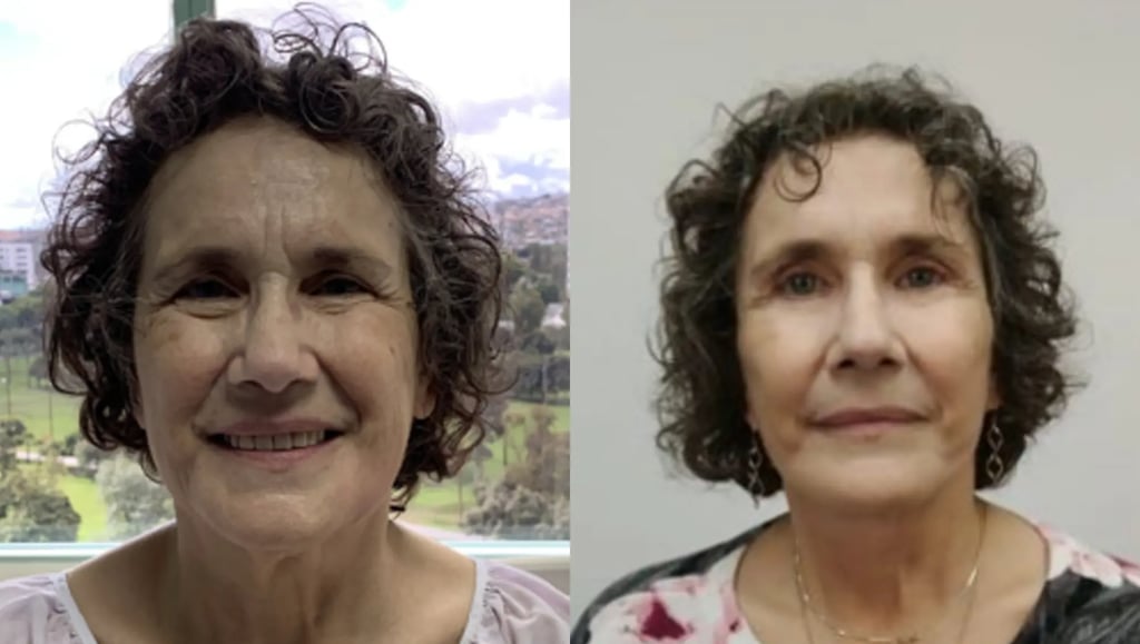 Before and after photos of upper and lower blepharoplasty in Tijuana, demonstrating the removal of eye bags and hooded lids.
