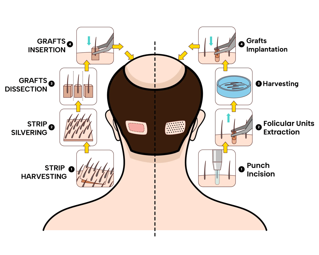 Hair Restoration in Tijuana, Mexico 14 Infographic diagram comparing the steps of FUE (Follicular Unit Extraction) and FUT (Strip Harvesting) for hair restoration in Tijuana, detailing the harvesting and implantation process.