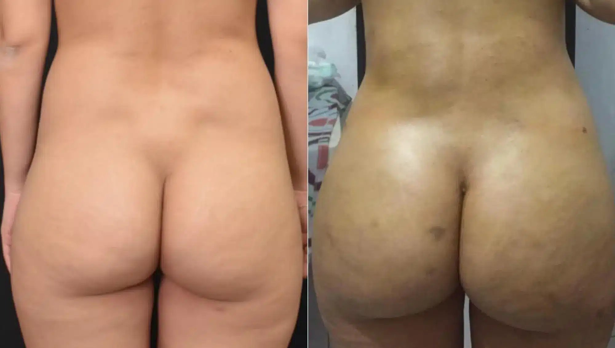 Rear view comparison of a patient before and after Brazilian Butt Lift in Tijuana, showing correction of hip dips and significant volume increase via Brazilian butt augmentation.