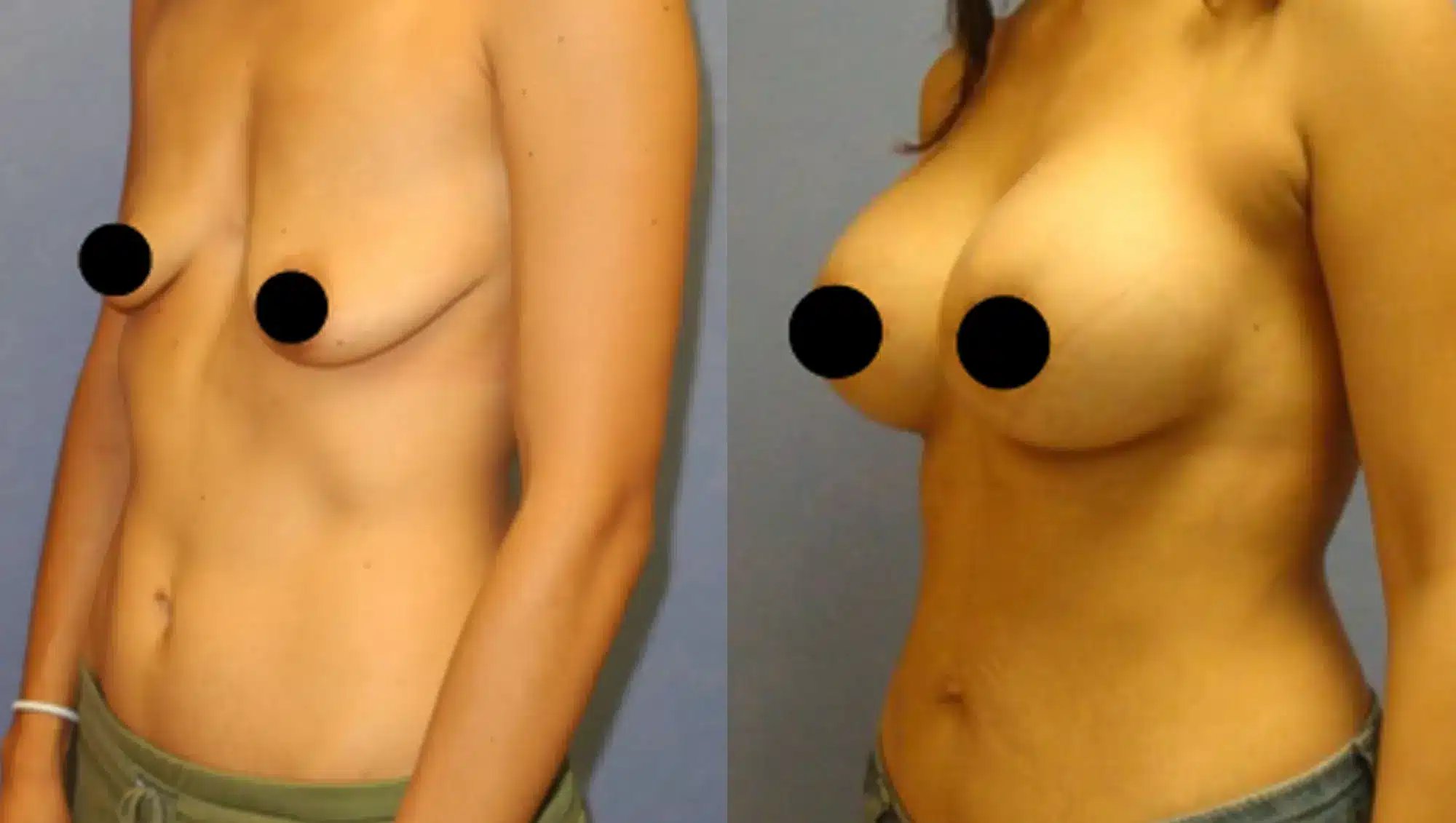 Side view of before and after results for an affordable breast lift in Tijuana.