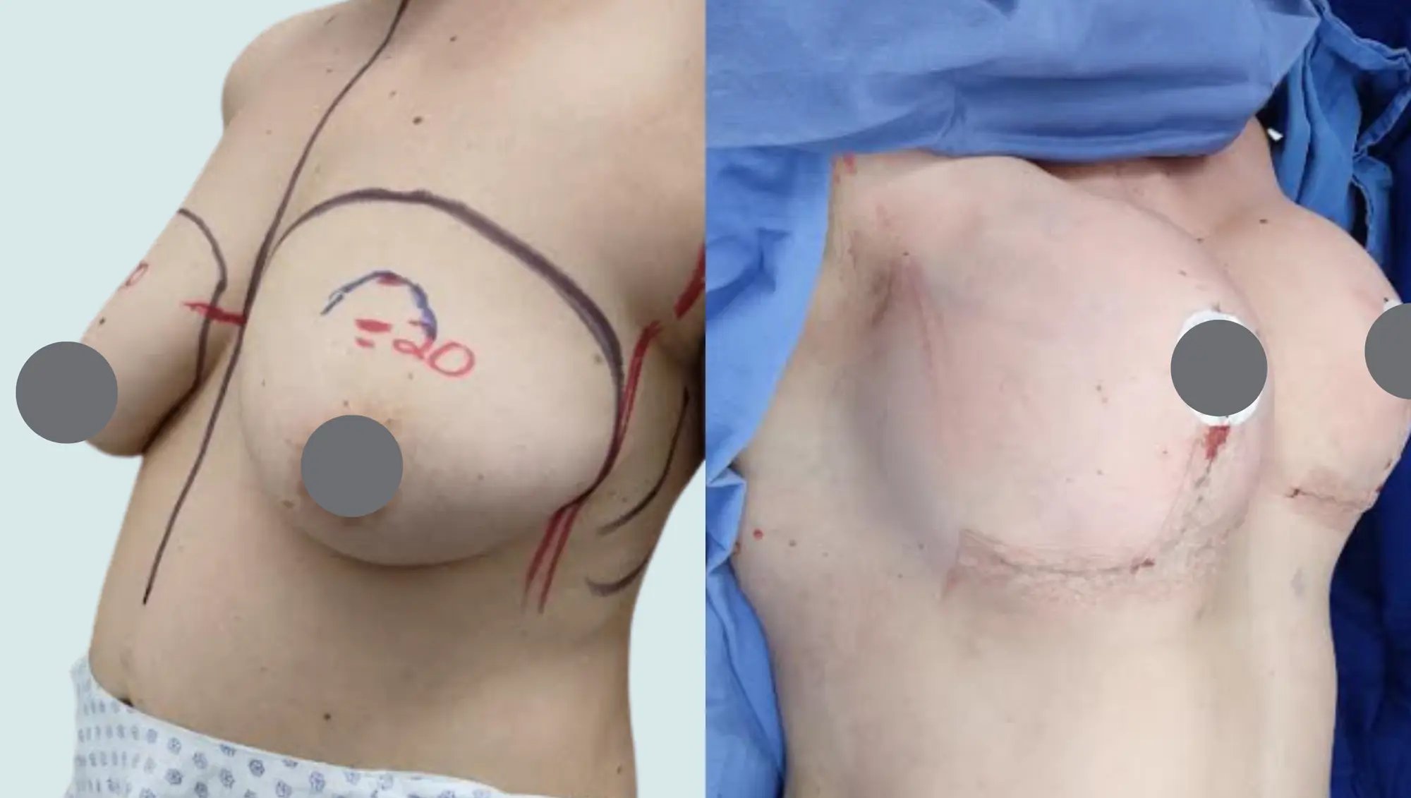 Before and after breast lift in Tijuana showing surgical markings and immediate lifting results.