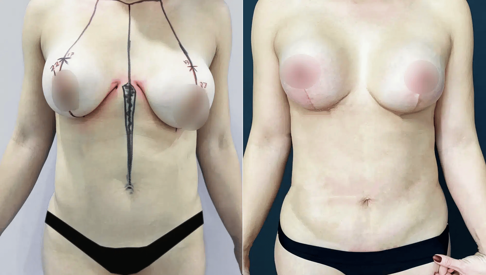 Breast Reduction In Tijuana, Mexico 15 Resultados de mastopexy reduction Tijuana: comparativa de marcas quirúrgicas y resultado final del levantamiento.