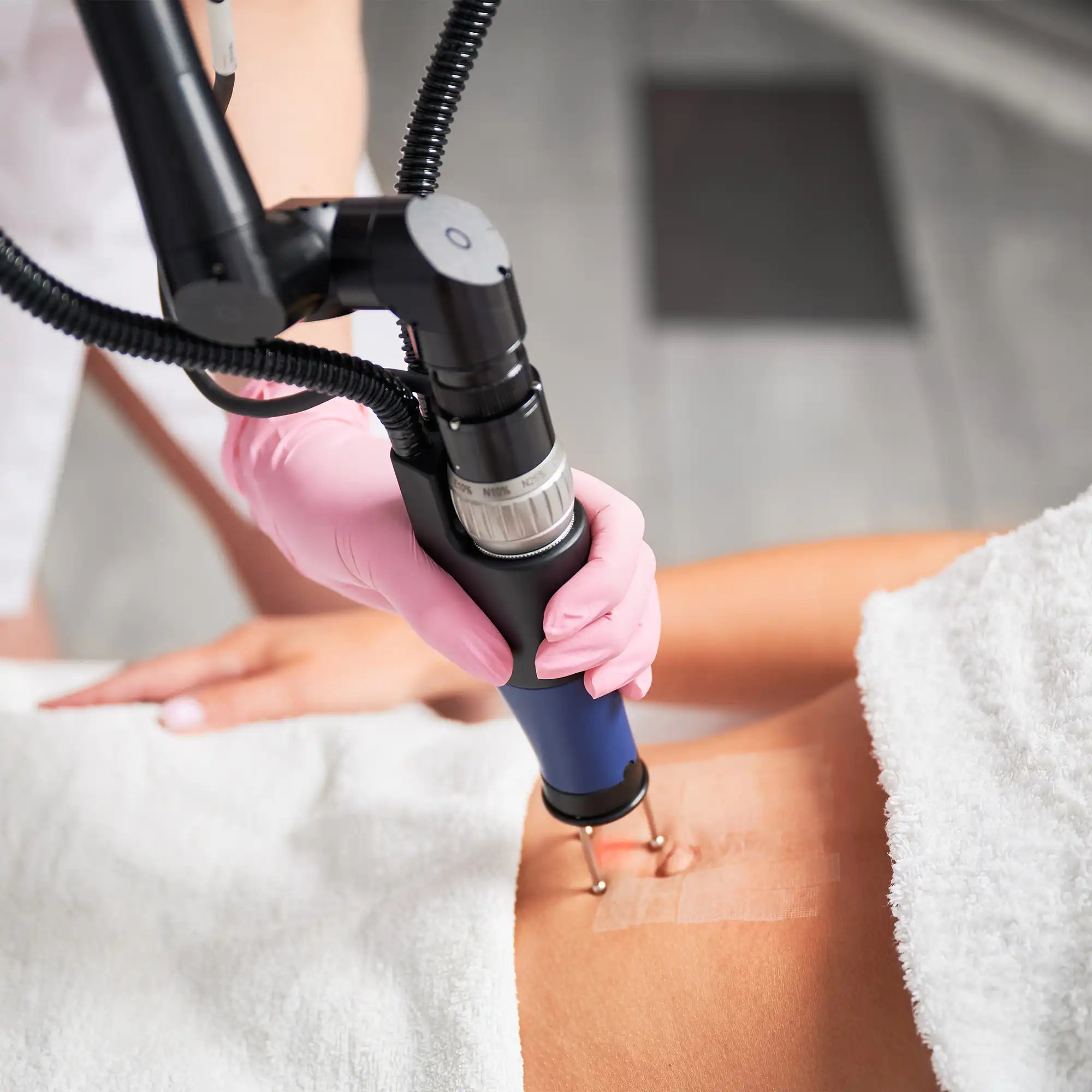 Liposuction in Tijuana, Mexico 17 Specialist applying a radiofrequency skin tightening device to a patient's abdomen after liposuction in Tijuana, ensuring firm skin and smooth body contouring.