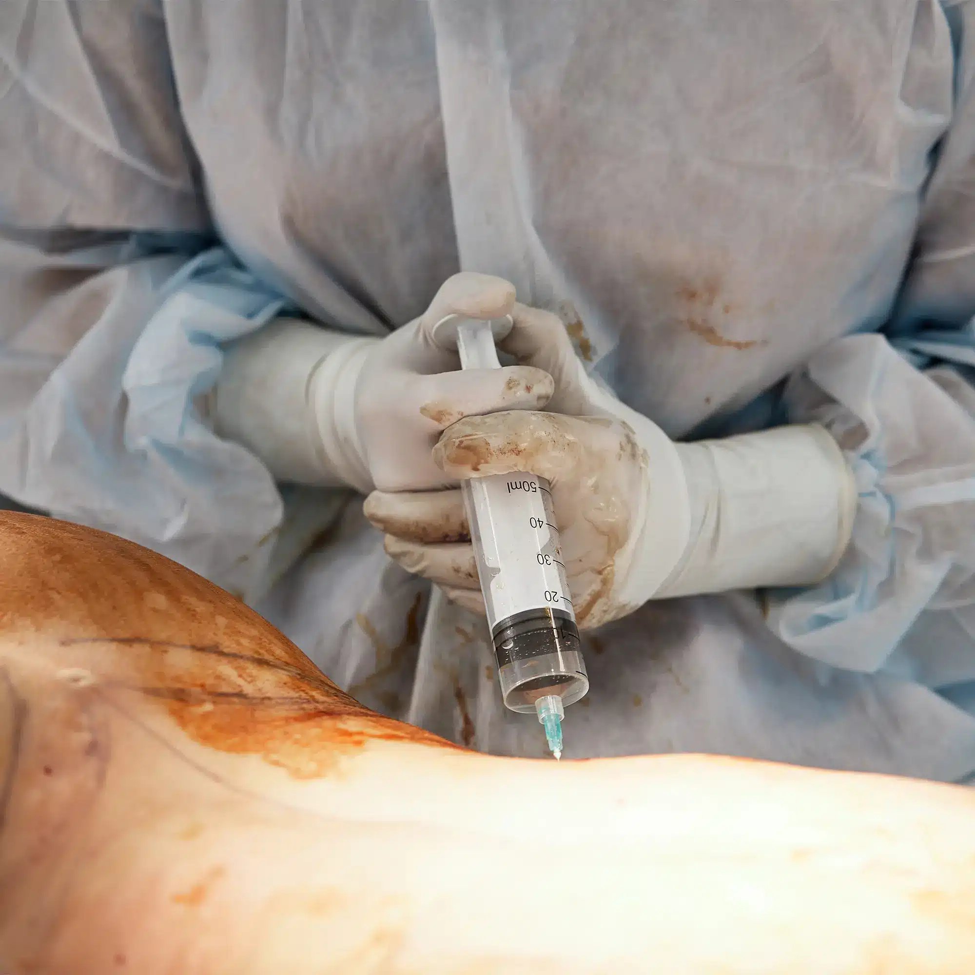 Liposuction in Tijuana, Mexico 18 Surgeon handling a syringe filled with harvested fat for a Brazilian Butt Lift (BBL) or fat transfer procedure during liposuction in Tijuana, Mexico.