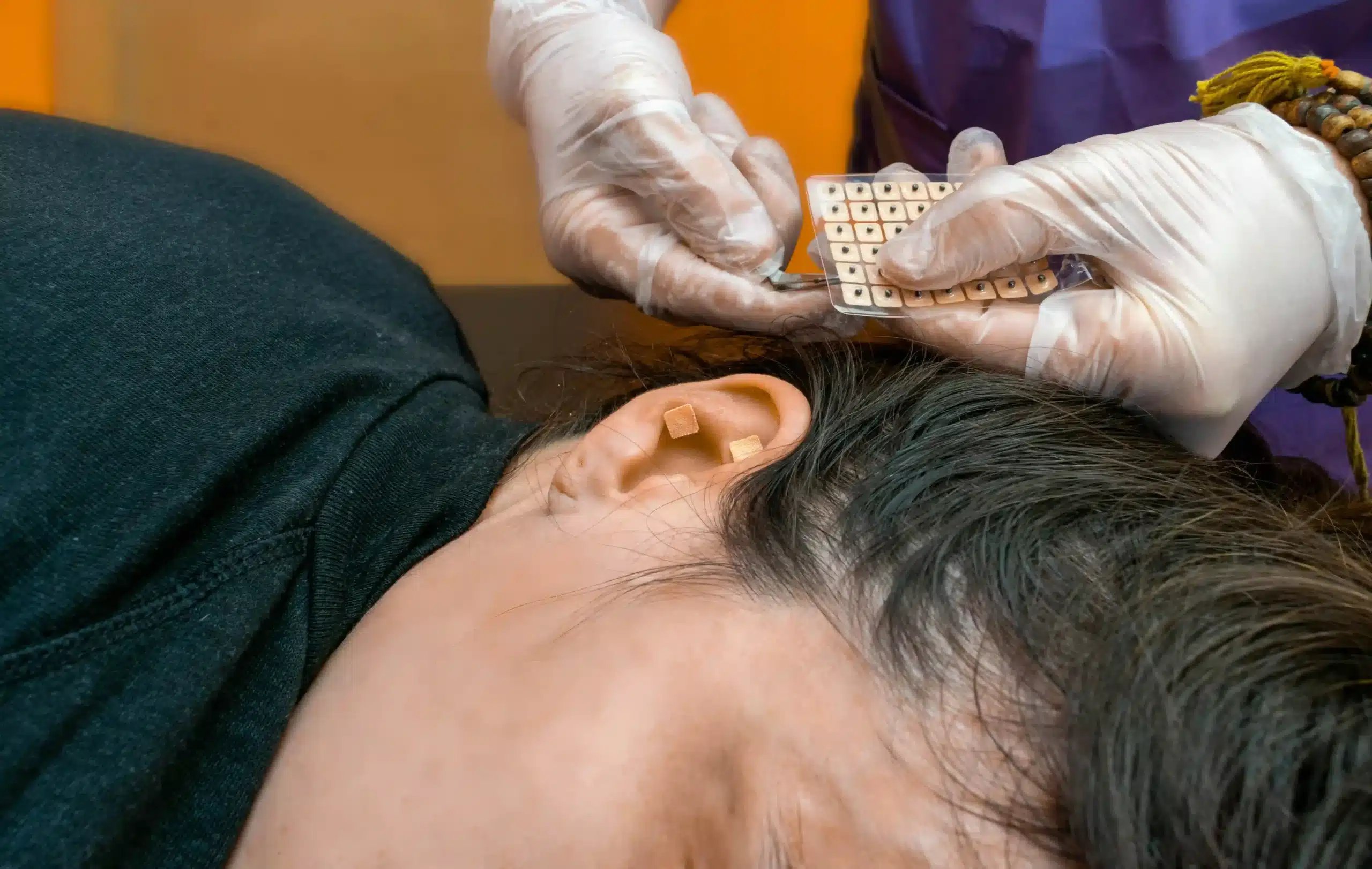 Hair Implants in Tijuana, Mexico 11 Hair transplantation in Tijuana showing a specialist preparing follicles for a patient's hair restoration treatment.