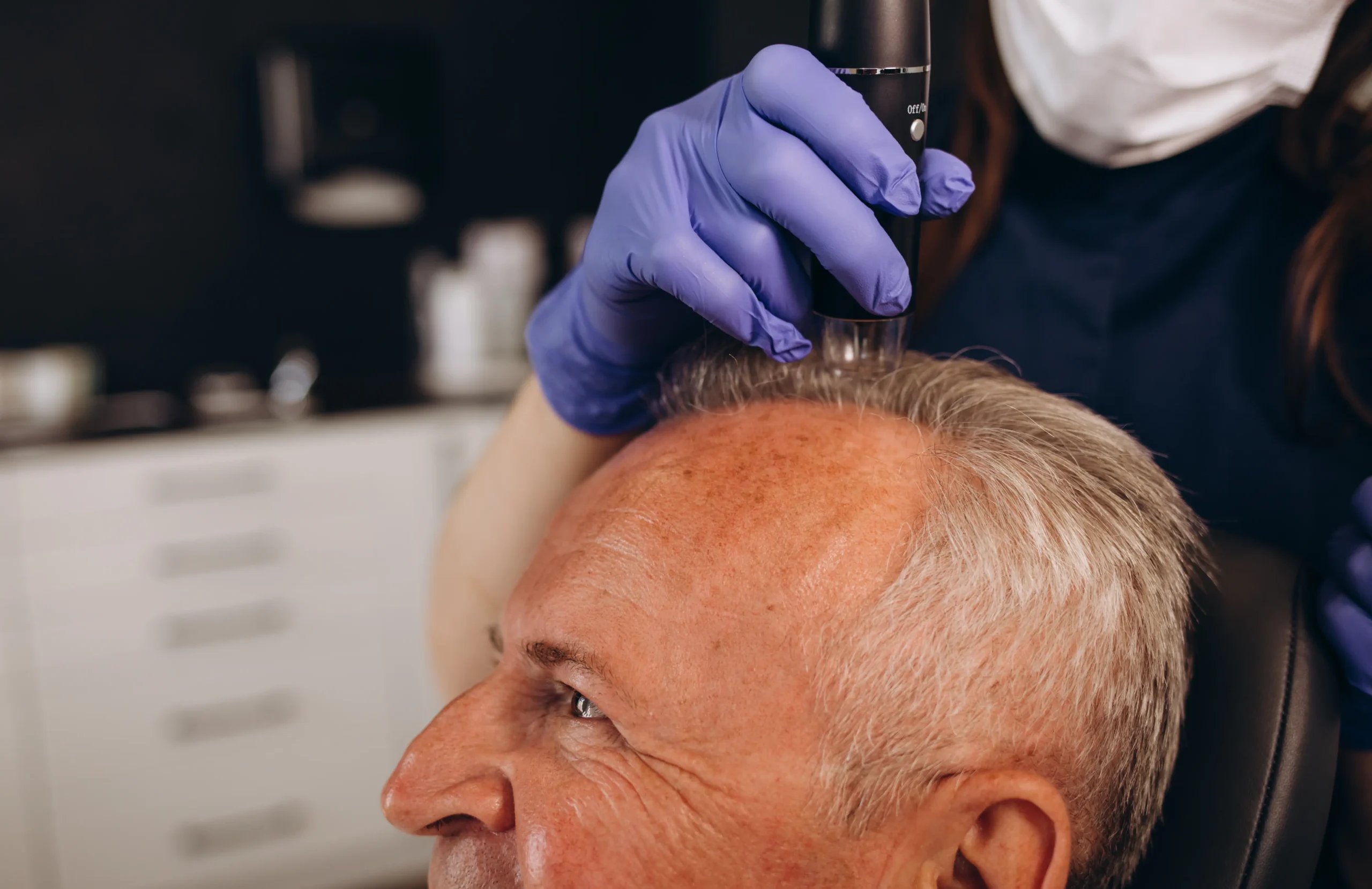 Hair Implants in Tijuana, Mexico 13 A hair restoration specialist in Tijuana applying a specialized treatment to a patient.