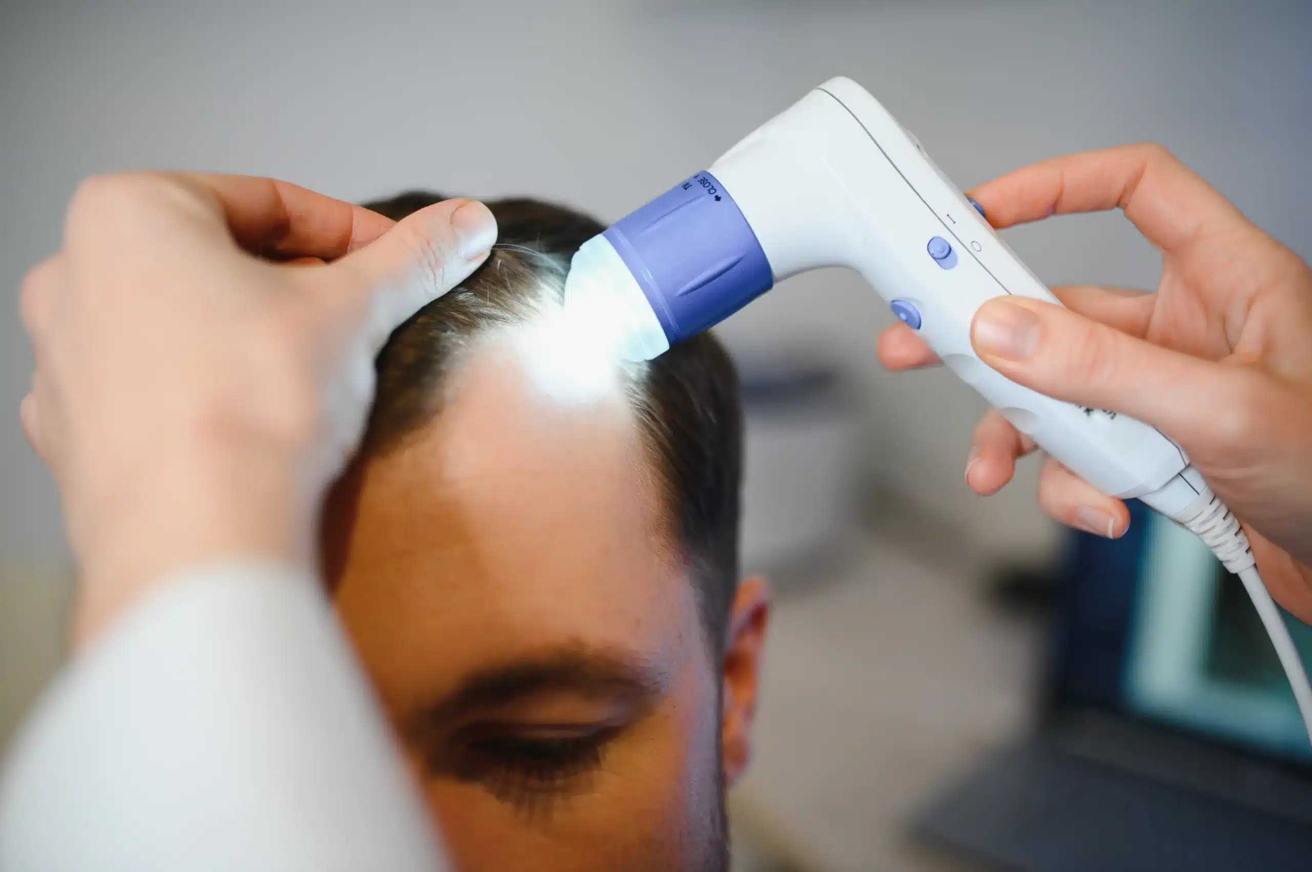 Hair Restoration in Tijuana, Mexico 11 Trichologist using a digital dermatoscope to examine a patient's hairline and donor density, preparing for hair restoration in Tijuana and hair implants.