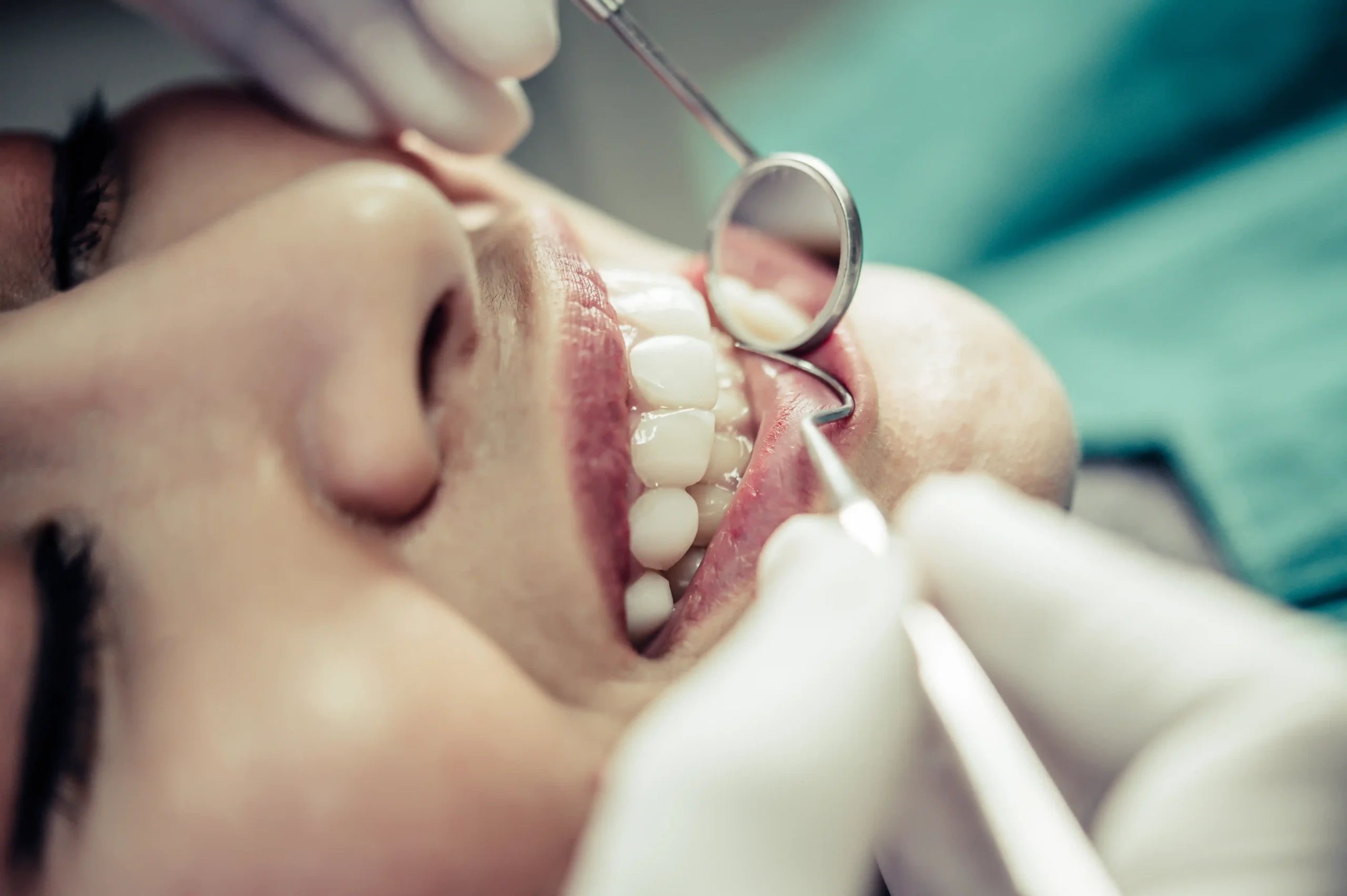 Mouth Reconstruction in Tijuana, Mexico 14 Close-up of a patient receiving a full mouth restoration in Mexico with high-quality crowns and veneers.