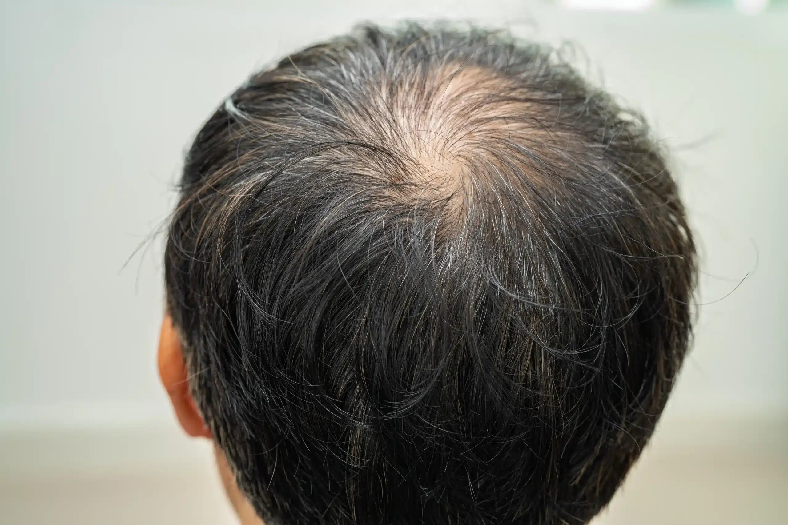 Hair Restoration in Tijuana, Mexico 13 Top view of a man's head showing significant hair thinning at the crown (vertex), illustrating a common target area for hair restoration in Tijuana and hair implants.
