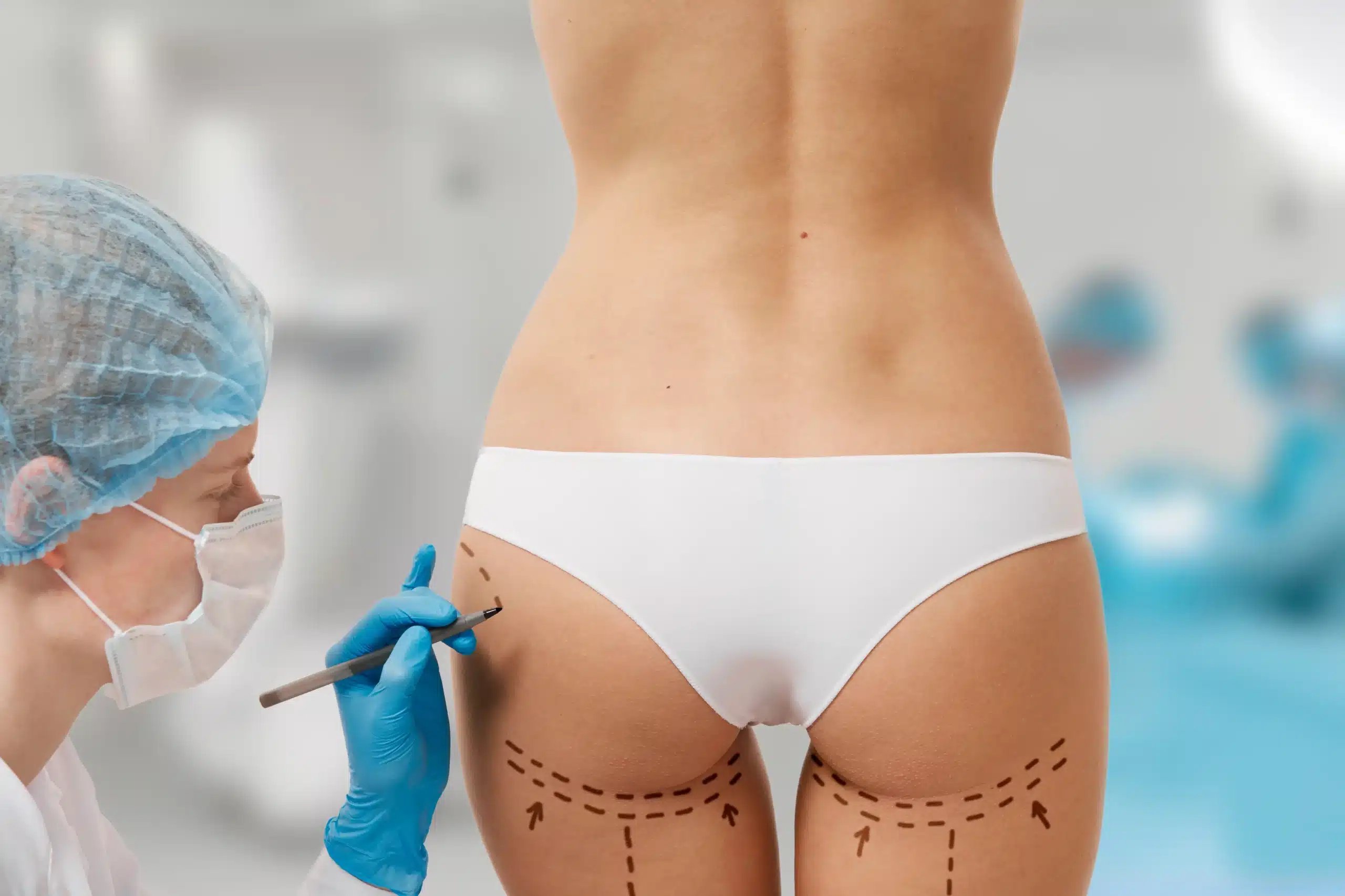 Brazilian Butt Lift in Tijuana, Mexico 14 Plastic surgeon marking lifting vectors on a patient's buttocks before a Brazilian Butt Lift in Tijuana, ensuring precise results for Brazilian butt augmentation.