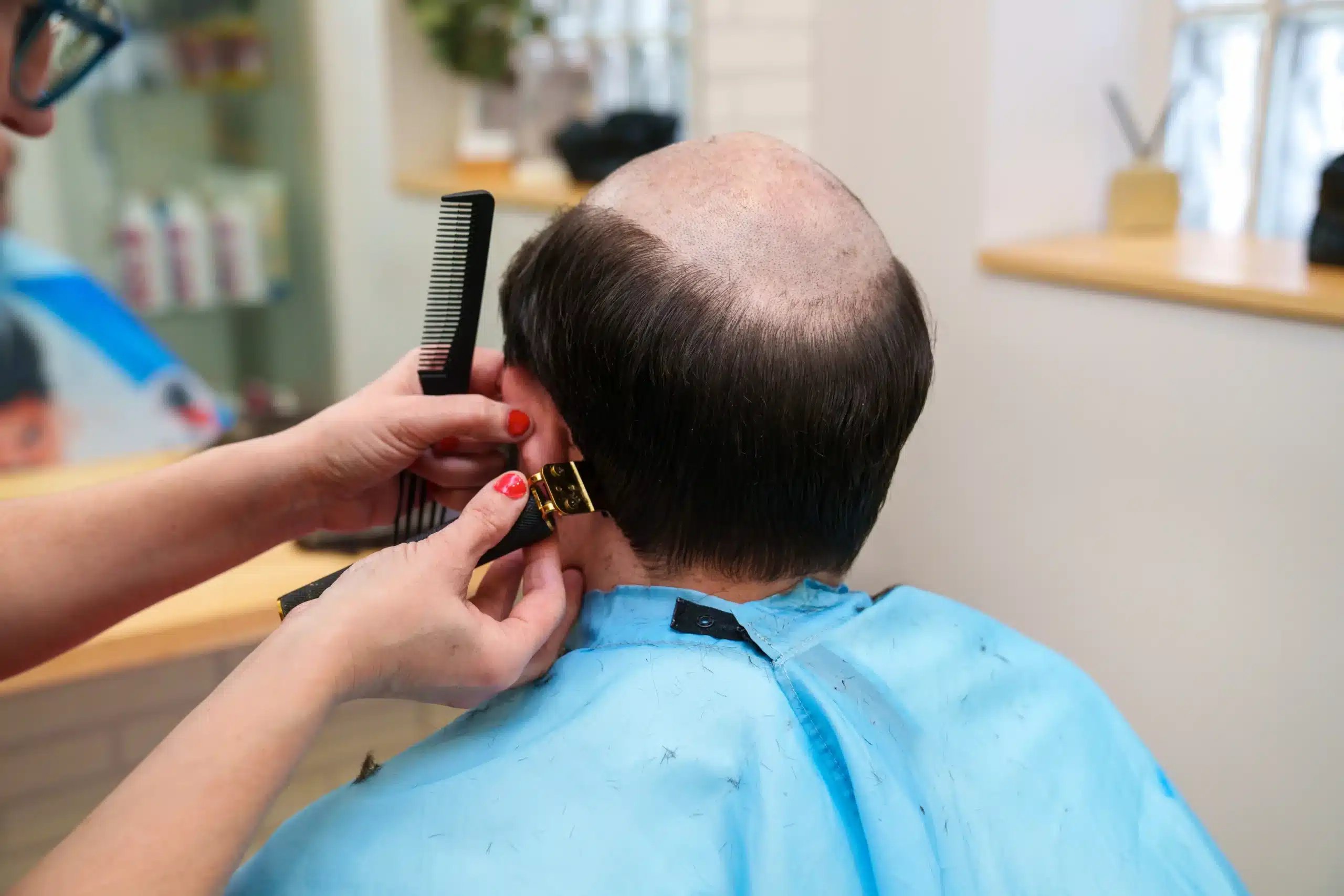 Hair Implants in Tijuana, Mexico 12 A hair transplant specialist in Tijuana preparing a patient's scalp for a restoration procedure.