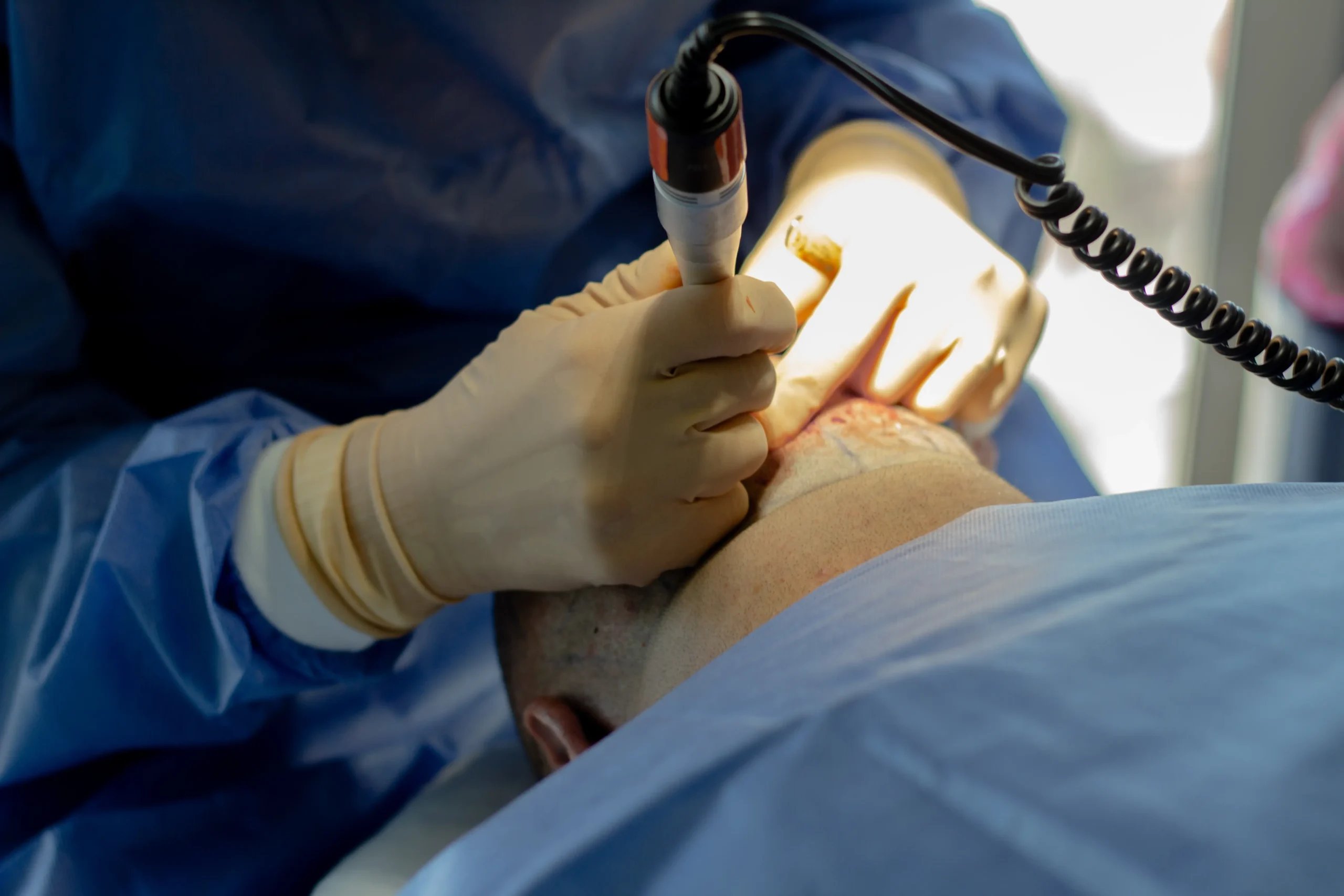 Hair Transplant in Mexico – What You Need to Know Before You Book 3 Hair transplantation specialist in Tijuana using precision tools for a FUE hair restoration procedure.