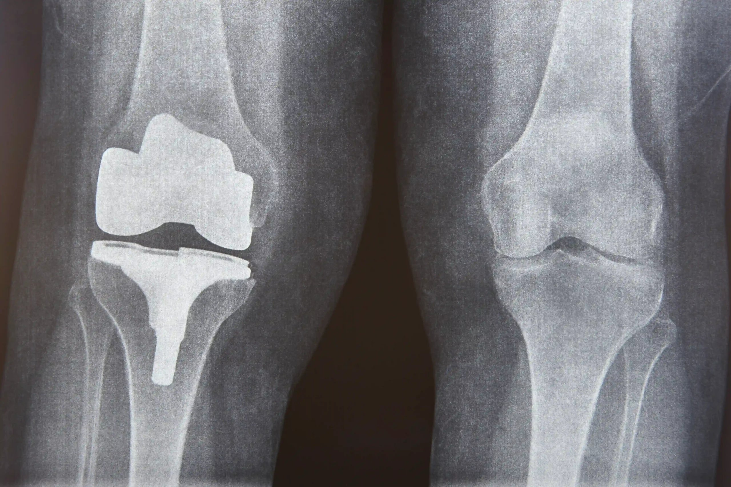 Knee Replacement in Tijuana, Mexico 12 X-ray comparison of a natural knee with osteoarthritis and a successful titanium implant after knee replacement in Tijuana.