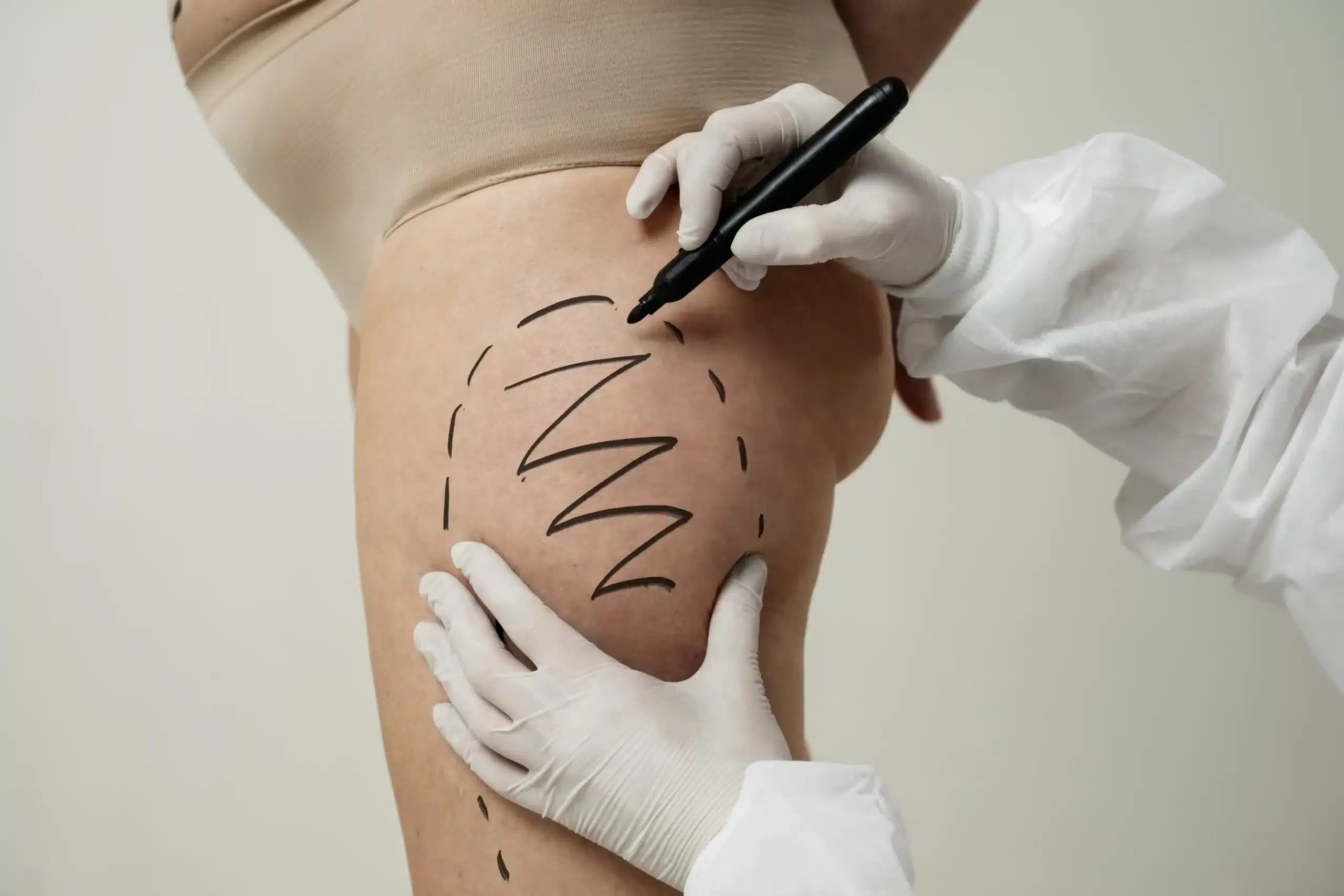 Thigh Lift in Tijuana, Mexico 12 Surgeon drawing surgical traces on a patient's leg for an affordable thigh lift in Tijuana.