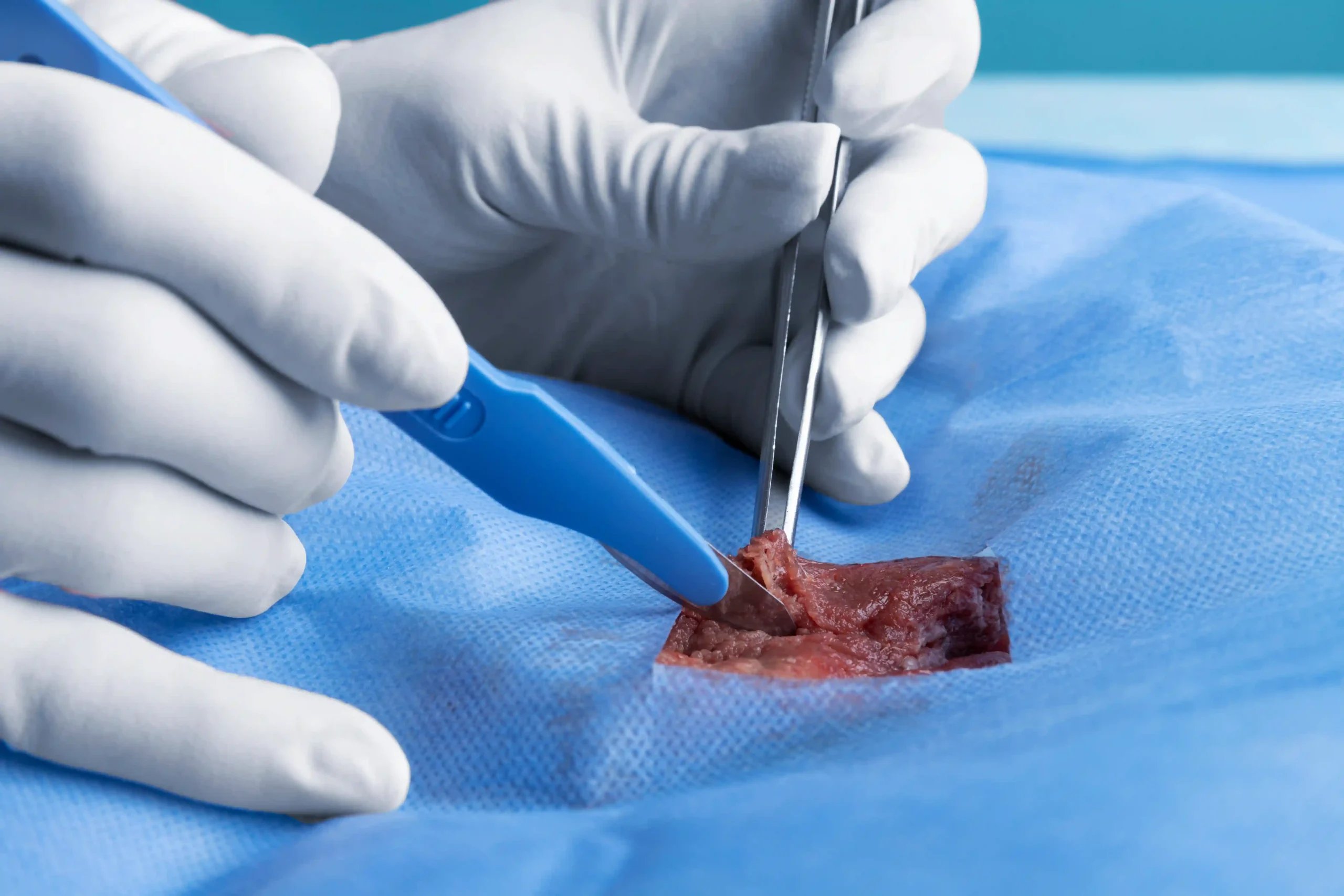 Hernia Repair in Tijuana, Mexico 15 Close-up of a board-certified general surgeon in Mexico performing a precise incision for a safe hernia surgery procedure.