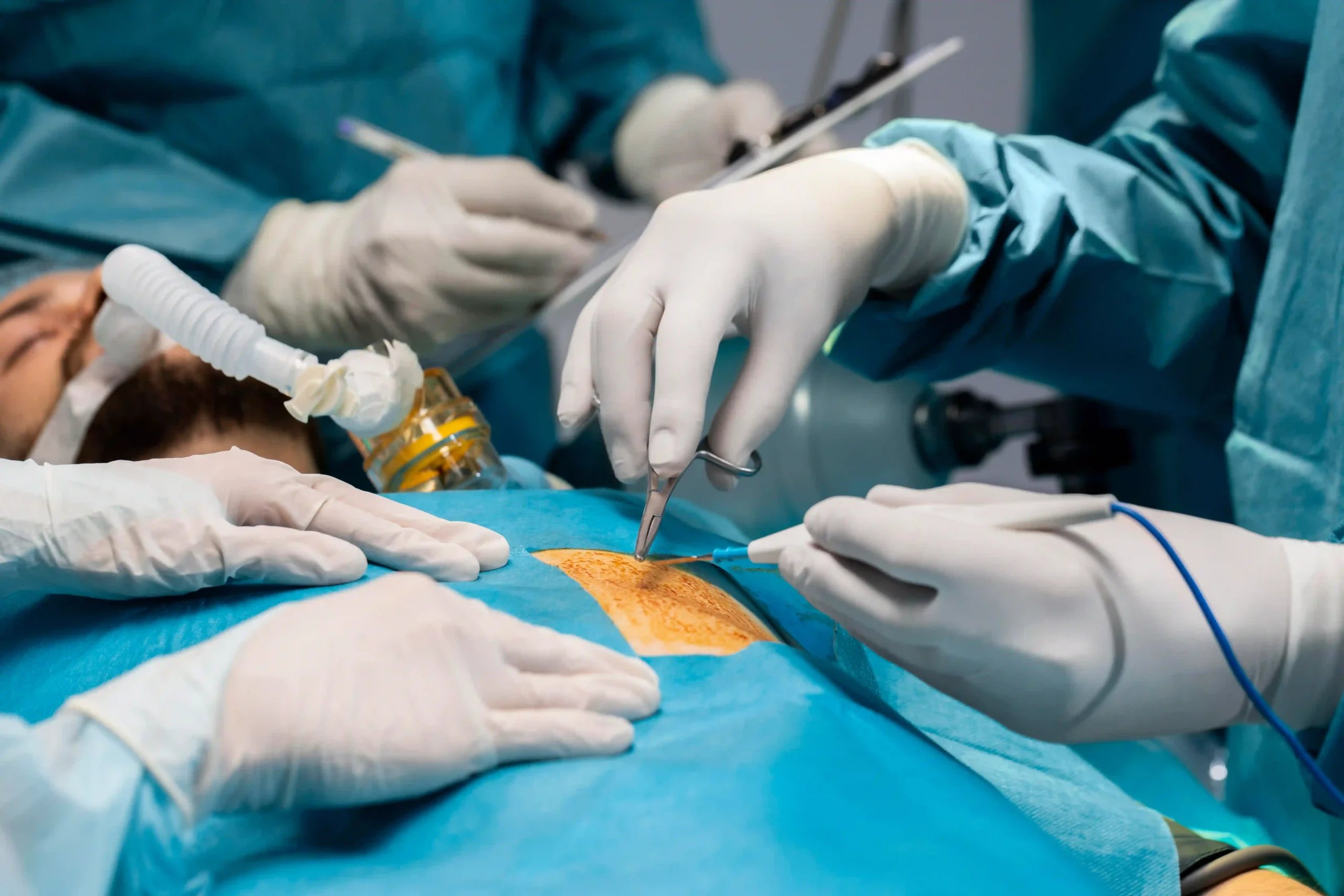 Hernia Repair in Tijuana, Mexico 11 Board-certified general surgeons in Mexico performing a safe hernia surgery procedure using advanced surgical tools.