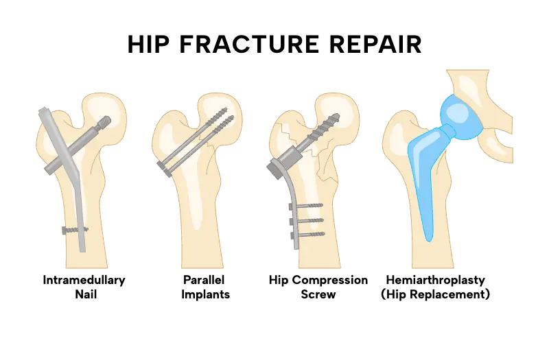Hip Replacement in Tijuana, Mexico 14 Medical diagram illustrating hip fracture repair methods: Intramedullary Nail, Parallel Implants, Compression Screw, and Hemiarthroplasty for hip replacement in Tijuana.