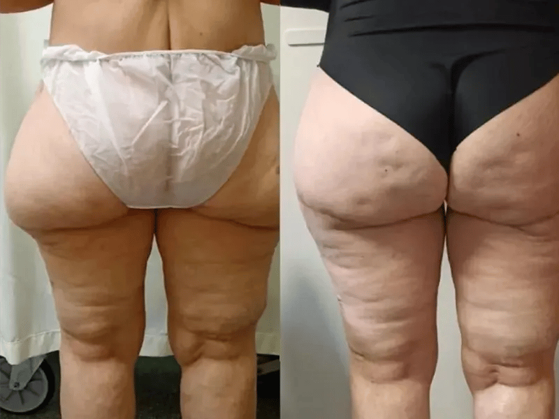 Medical Tourism in Tijuana | Affordable Surgery Packages 19 thigh lift