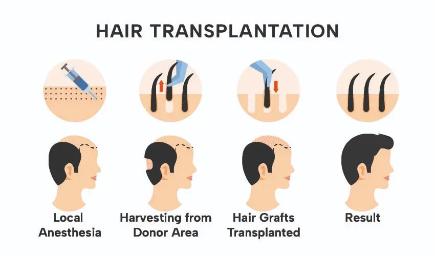 Hair Implants in Tijuana, Mexico 14 A hair restoration specialist in Tijuana providing complementary auriculotherapy for patient wellness.