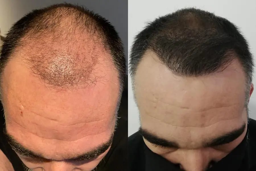 Top view before and after hair regrowth in Tijuana treatment, showing full coverage of the crown area.