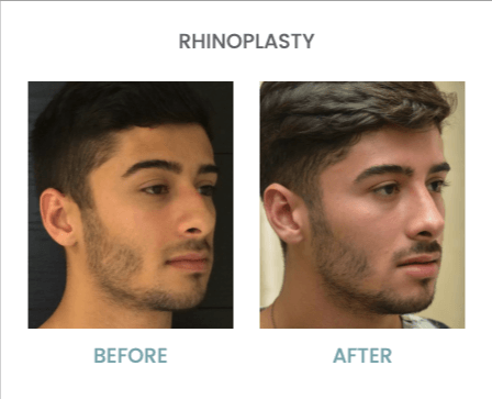 Types of nose Rhinoplasty