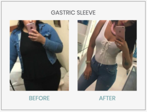 gastric bypass mexico