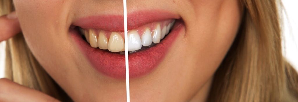 Smile Again Comfortably Thanks to Dental Implants in Mexico