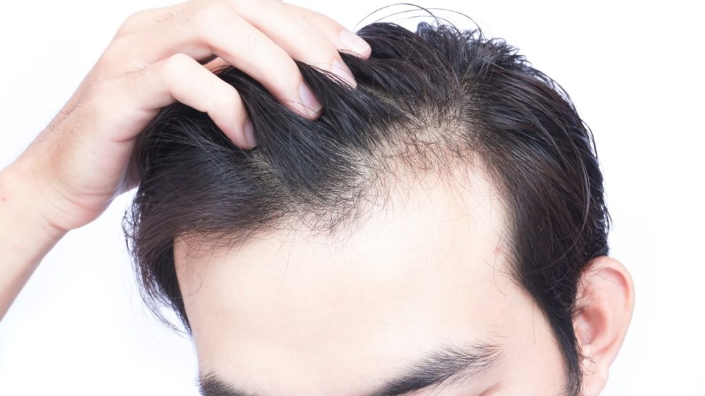 Hair Transplant in Mexico: How Long Does It Last?
