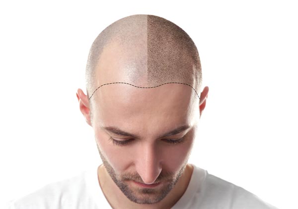 Alopecia—Is Hair Transplant in Mexico the Solution?