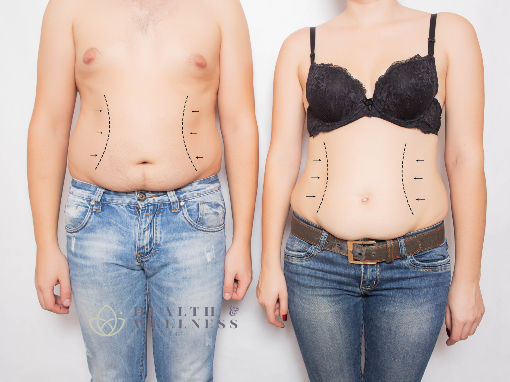 How Do I Know If I Am a Good Candidate for Liposuction in Tijuana?