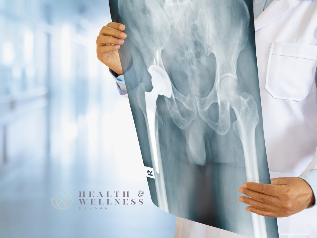 The Relationship Between Hip Replacement Mexico & Affordable Healthcare
