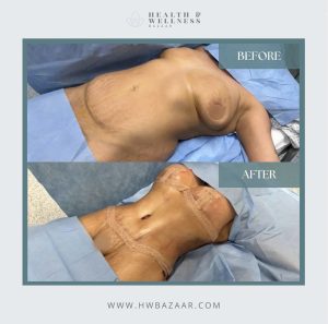 Plastic Surgery in mexico 