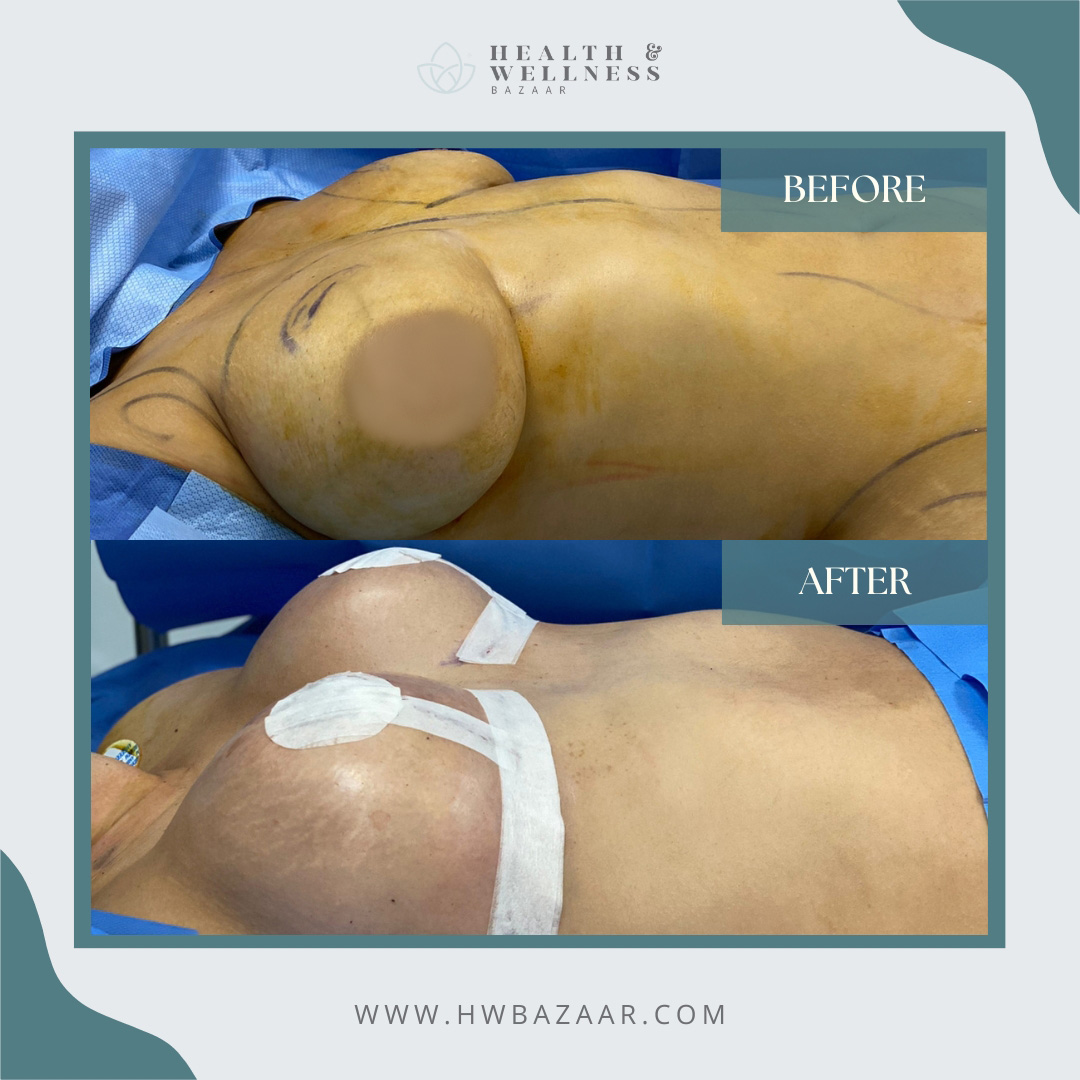 Breast Revision  Plástica Tijuana, Reconstructive Procedures