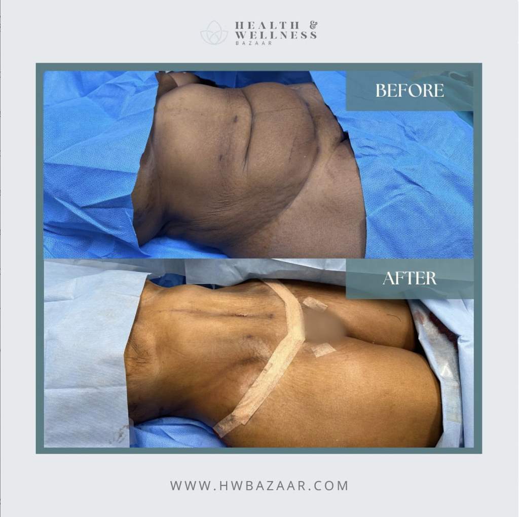 Plastic Surgery After Weight Loss in Mexico – The Solution to Excess Skin